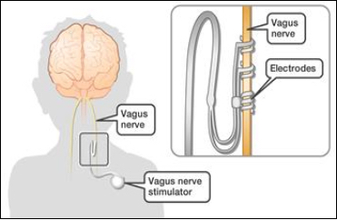 Vagus nerve stimulation device and electrode placement